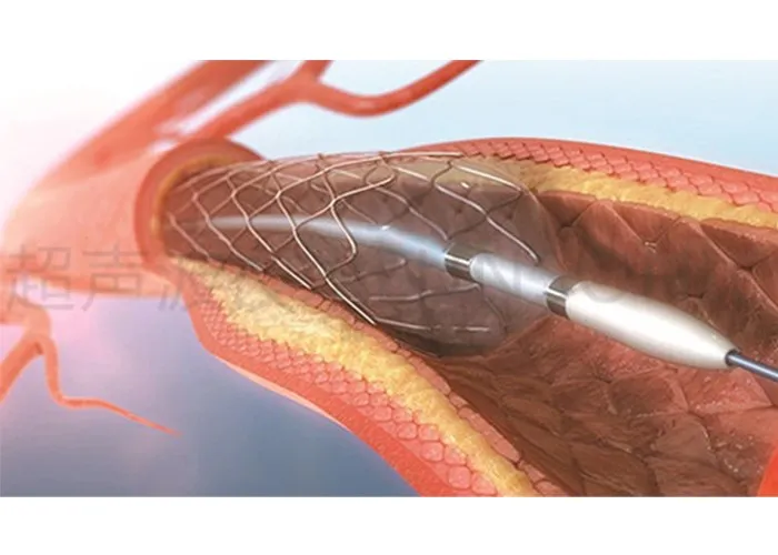 Drug elution balloon catheter ultrasonic spraying 9 Drug elution balloon catheter ultrasonic spraying 9